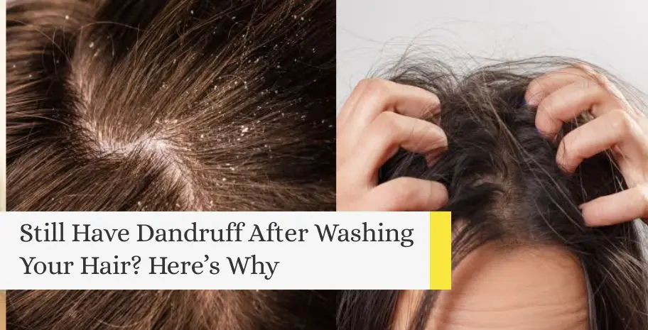Image showing dandruff hair on the left and itchy hair on the right